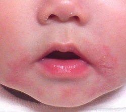 Ａ　玉ねぎアレルギーで下痢や吐き気、かゆみなどの症状が起こる場合の対策は？_html_1f1fec55
