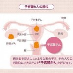 子宮頸がんは予防できるって知っていますか？